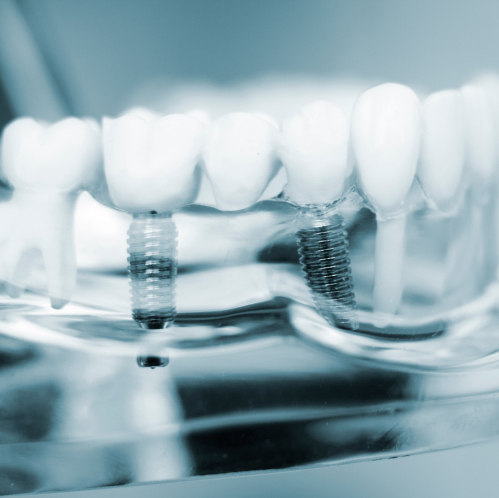 Dental Implants